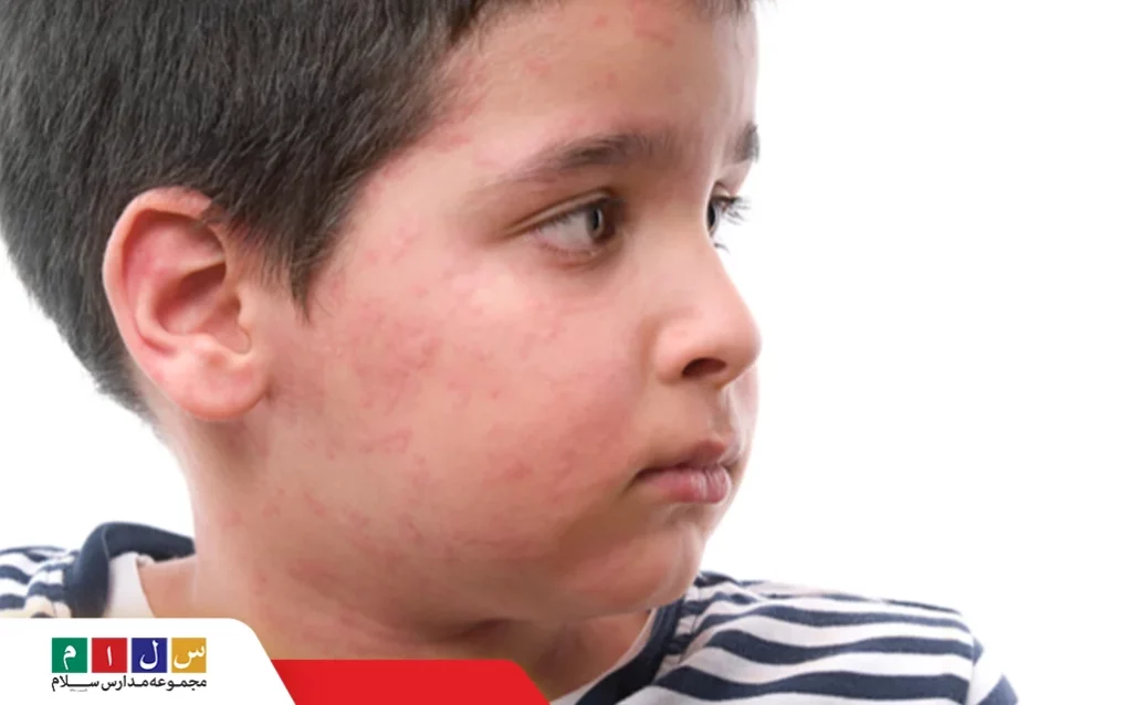 کمک‌های اولیه هنگام مواجهه با واکنش‌های آلرژیک کودک